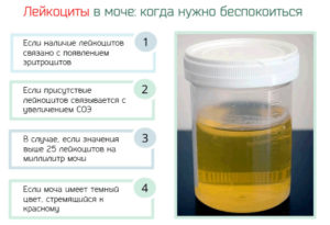Лейкоциты в моче 25