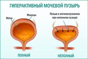 Проблемы с мочевым пузырем