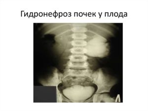 Гидронефротическая трансформация правой почки плода