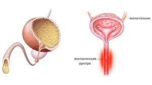 Уретрит простатит лекарства