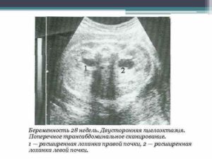 Расширение лоханки почек при беременности