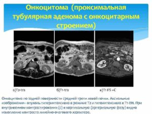 Диагностика онкоцитома почки