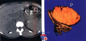 Мкб 10 доброкачественное образование надпочечника