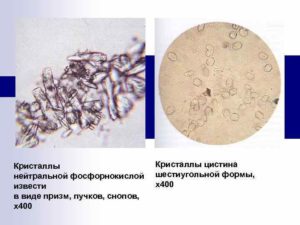 В моче фосфорнокислая известь