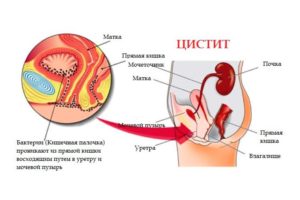 Кто вылечил цистит навсегда