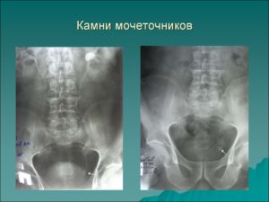 Камень в нижней трети мочеточника как вывести