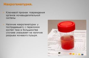 Кровь в моче у мужчины причины и лечение народными средствами