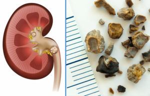 Канефрон при камнях в почках можно или нет