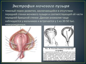 У кого нет мочевого пузыря