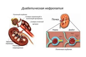 Чем поддержать почки при диабете