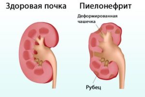 Воспаление почек симптомы и лечение препараты у детей