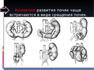 Аномальное развитие почек