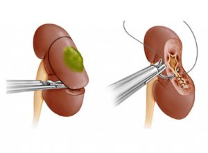 Как проходит операция на почках