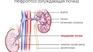 Опущение почки при планировании беременности