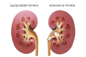 Как выявить болезнь почек