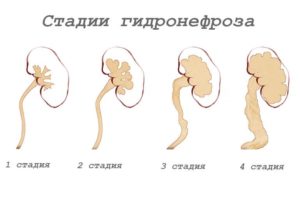 Признаки гидронефроза почки при беременности