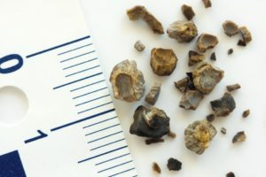 Как диагностировать камни в почках