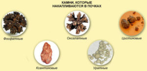 Канефрон при камнях в почках можно или нет