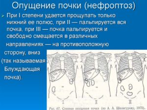 Нефроптоз 2 степени лечение препараты