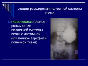 Полостная система почек