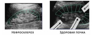 Нефросклероз почек на узи