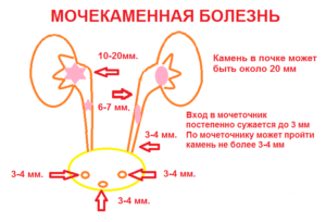 Схема мочеполовой системы у мужчин где появляются камни в почках