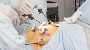 Сколько длится лапароскопическая операция на почке