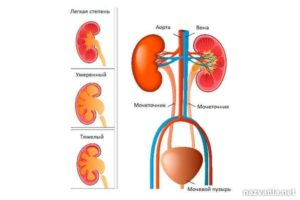 Почему расширены почечные лоханки