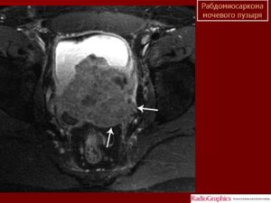 Саркома мочевого пузыря у ребенка