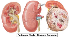 Опухоль вильмса почек