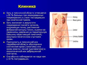 Болит почка справа при движении