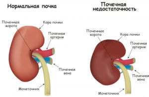 Почки при почечной недостаточности