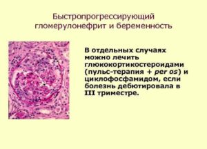 Быстропрогрессирующий гломерулонефрит лечить