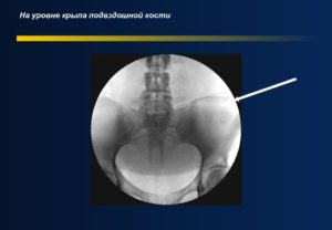 Почка на уровне подвздошной кости