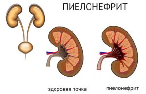 Пиелонефрит почек у детей что это такое