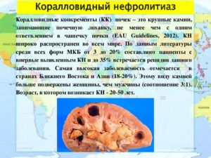 Нефролиты в почках что это