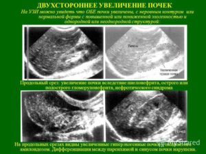 Признаки хронического пиелонефрита на узи почек