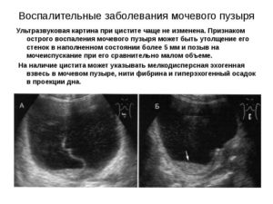 Взвесь в мочевом пузыре у ребенка причины