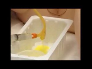 Как правильно промывать катетер из мочевого пузыря