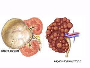 Киста на почке можно ли греть почку