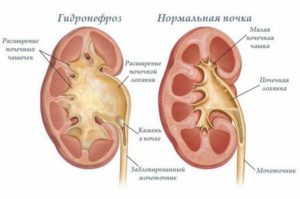 Чашечки в почках что это
