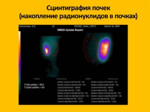 Сцинтиграфия почек в москве детям