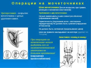 Операция на мочеточнике