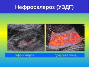 Нефросклероз почек на узи