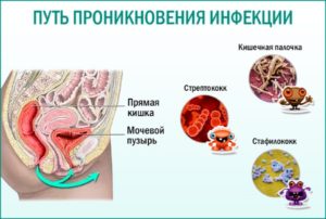 Мочеполовые инфекции у мужчин симптомы и лечение