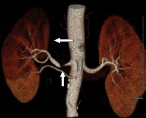 Удвоение артерий почек