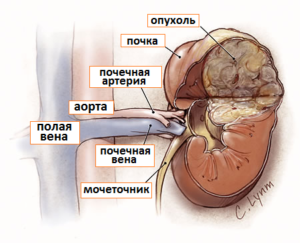 Что значит новообразование на почке