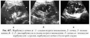 Карбункул почки лечение прогноз