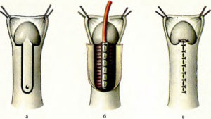 Стволовая гипоспадия у мальчиков