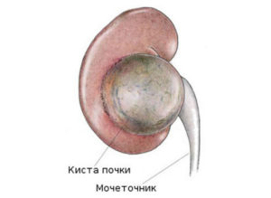 Большая киста почки что делать